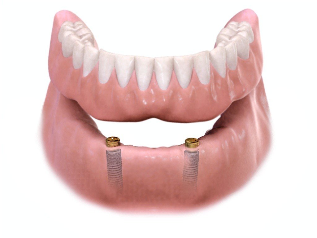 IMPLANT SUPPORTED DENTURES: The Better Kind of Dentures