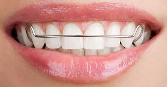 After Orthodontic Treatment – Retain Your New Smile Forever