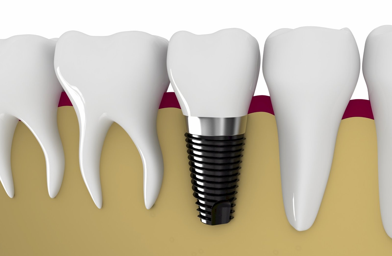 FAQ About Dental Implants