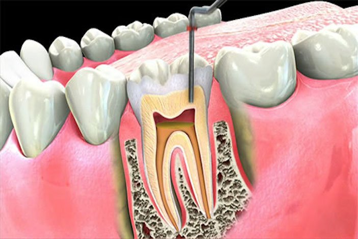 Root Canal Treatment: All That You Need To Know