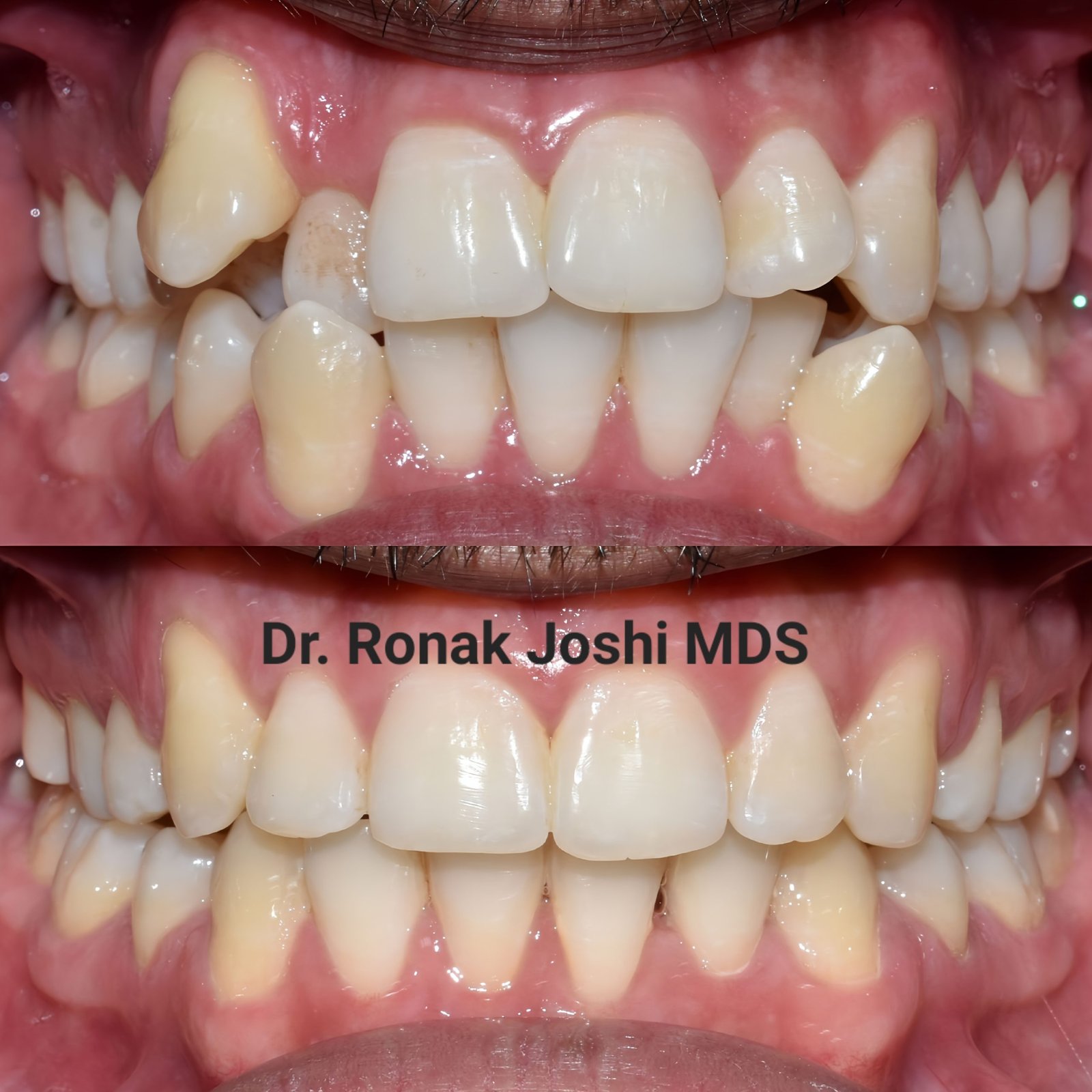 Why are straight teeth important?
