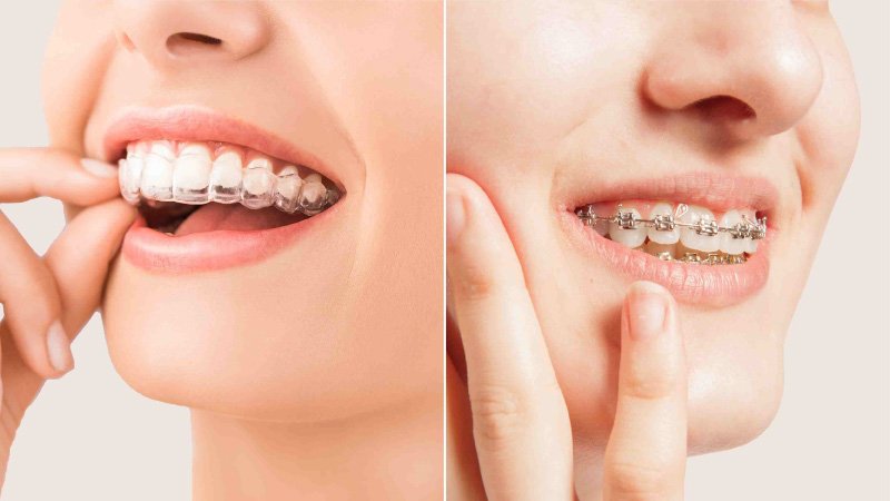 Align Your Smile: The Magic of Braces and Aligners