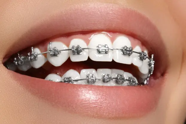 Brace Yourself: A Step-by-Step Guide to Braces Treatment at Anant Dental Clinic