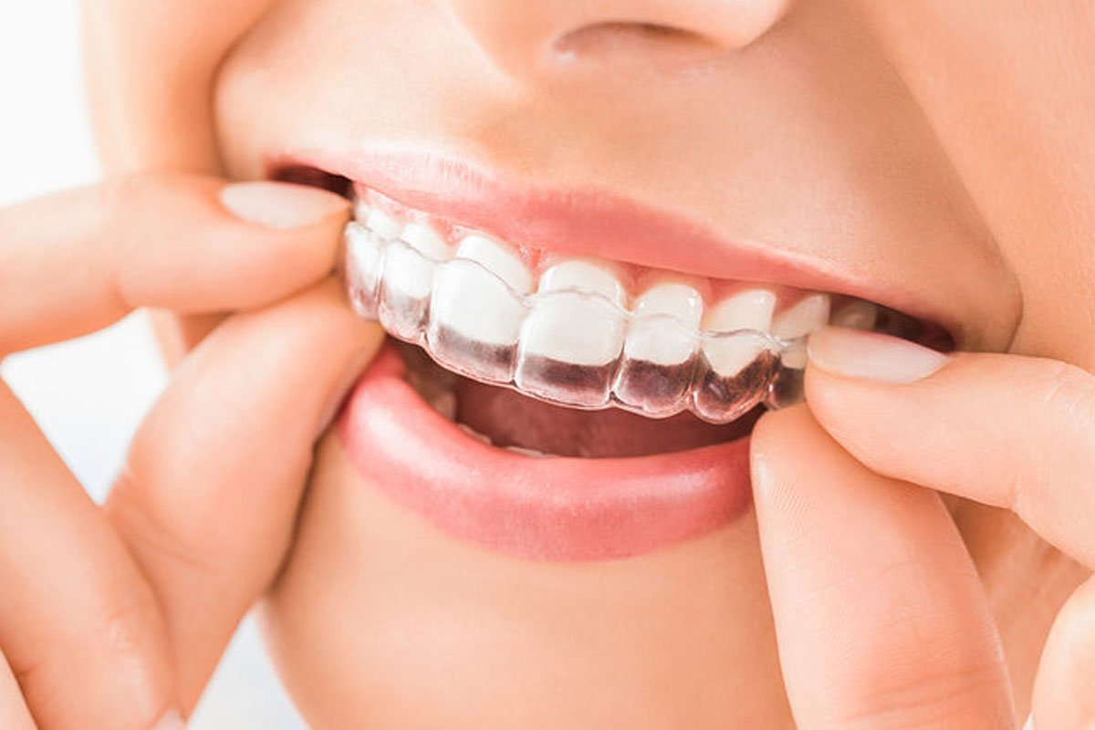 Smile Revolution: How Invisalign Aligners Correct Misaligned Teeth