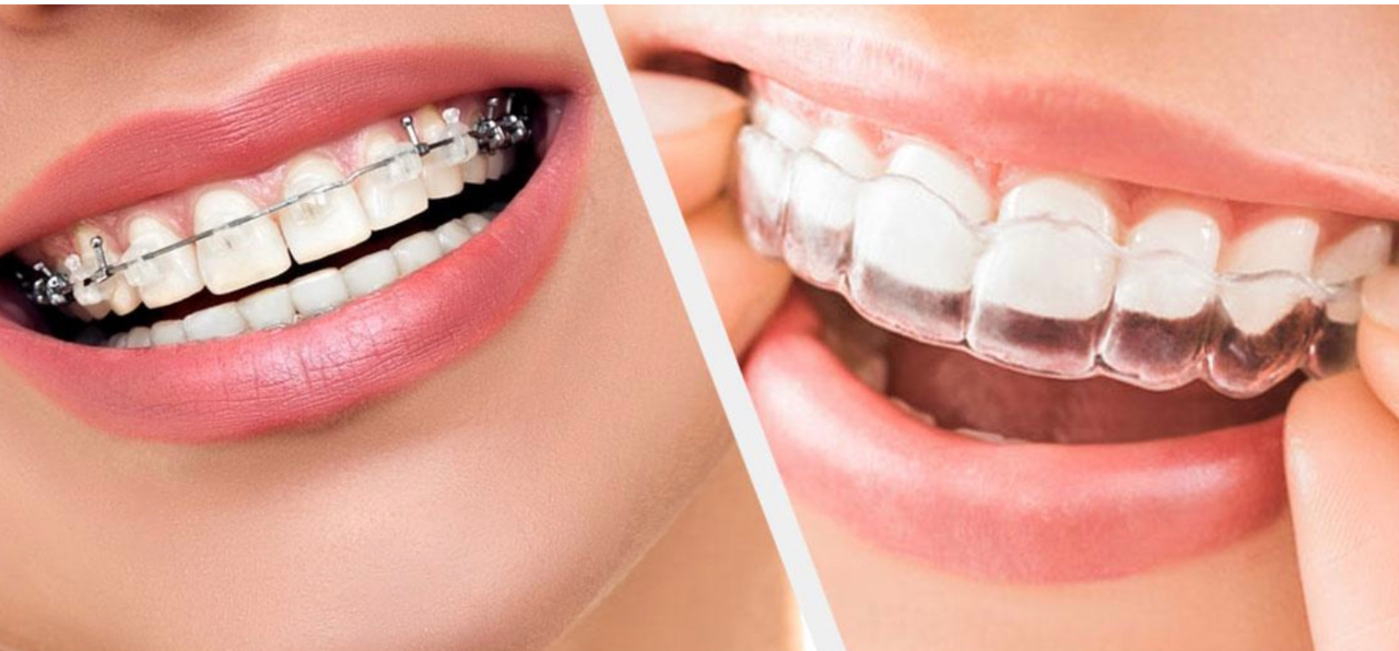 Smile Maintenance: Tips for Keeping Your Braces and Aligners Sparkling Clean