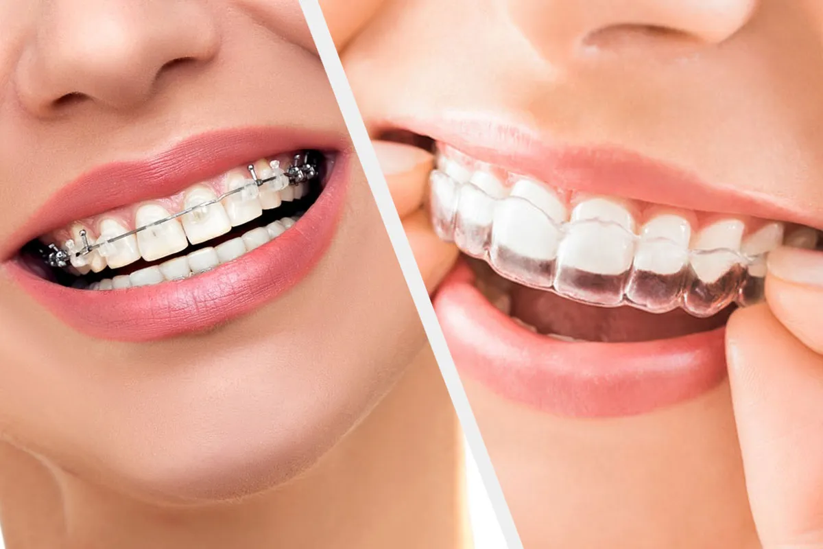 Invisalign vs. Braces: Making the Right Choice for Your Smile