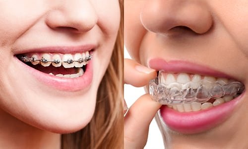 Braces and Aligners 101: Everything Parents Need to Know for Their Child’s Treatment