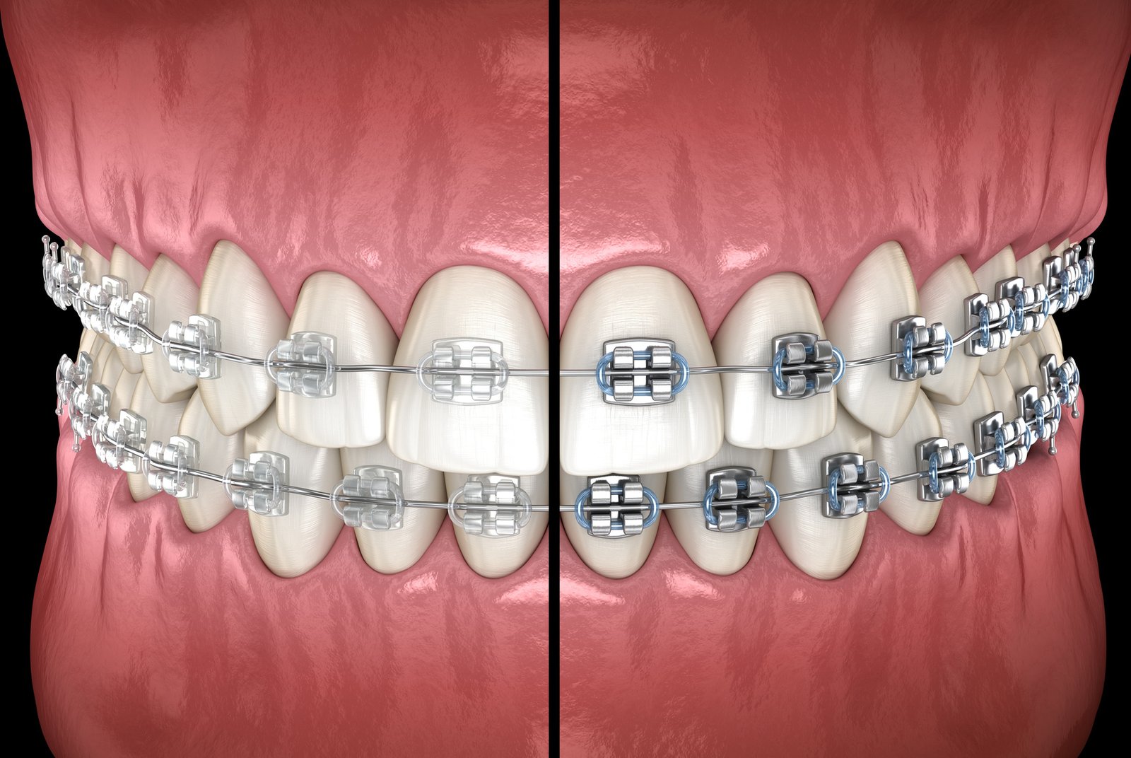 Choosing Your Braces: Understanding the Different Types for Your Orthodontic treatment