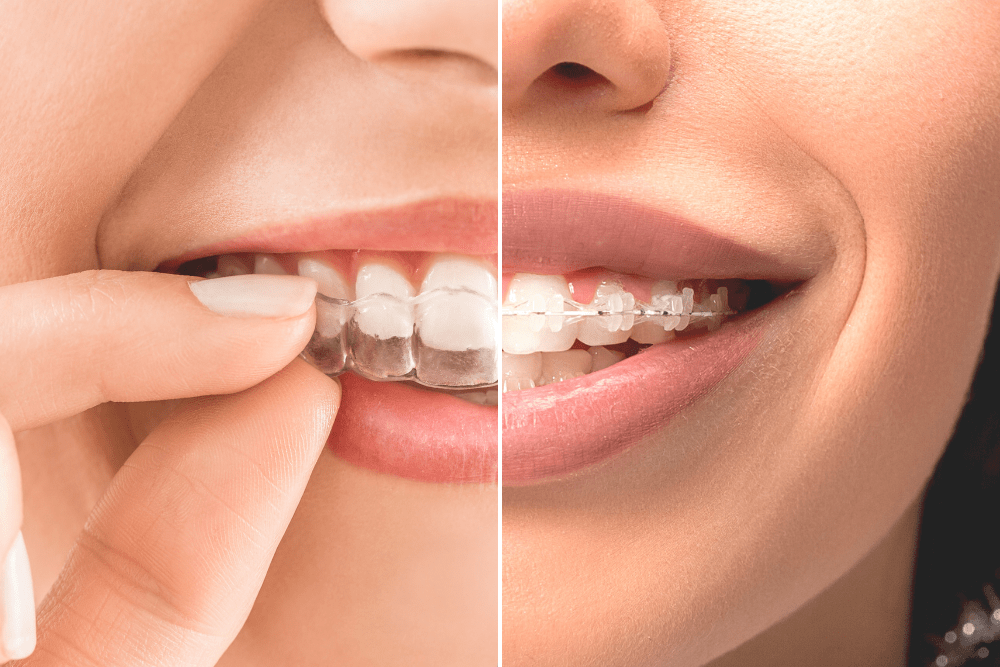 Healthy Smiles Start Here: How Braces and Aligners Benefit Your Oral Health