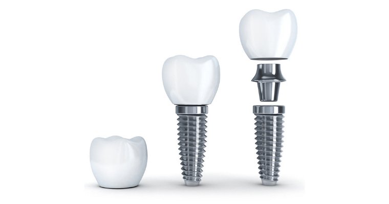 Why Choose Dental Implants? Exploring Their Advantages