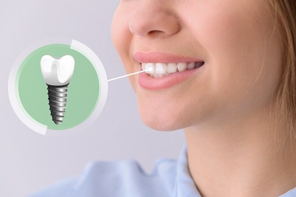 The Magic of Dental Implants: How They Transform Your Teeth