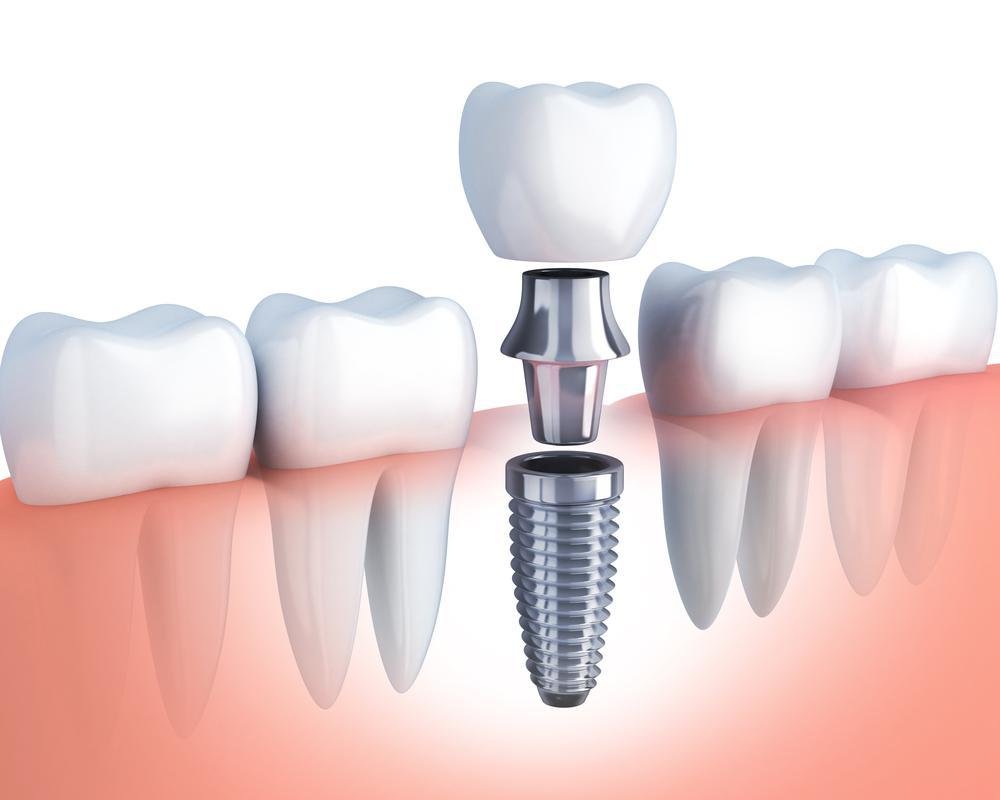Dental Implants: The Lasting Answer to Missing Teeth Woes