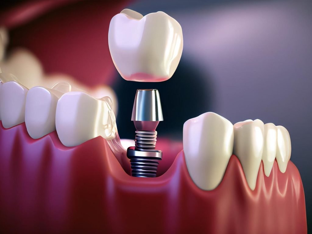 The Power of Mini Dental Implants: Everything You Need to Know