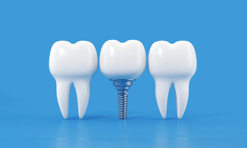 Maintaining Your Dental Implants: Tips for Long-Term Success