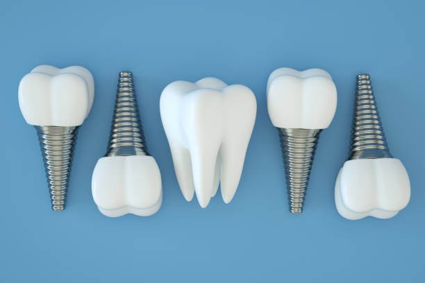 Choosing the Right Dental Implant: Understanding the Different Types