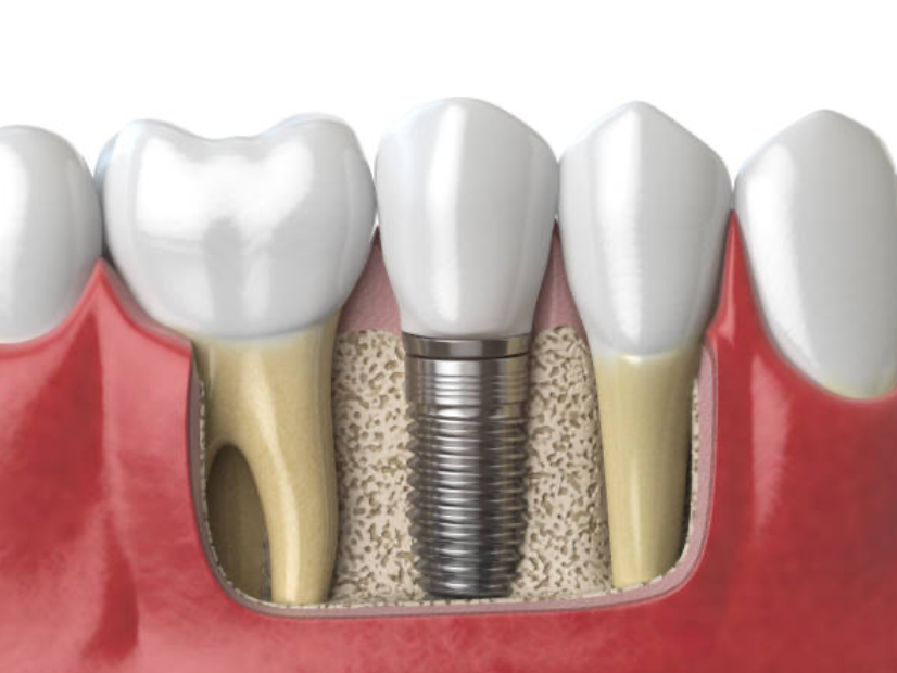 Navigating Risks: What to Know About Dental Implant Complications