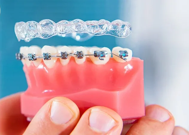 Brace Yourself: Handling Orthodontic Emergencies with Braces and Aligners