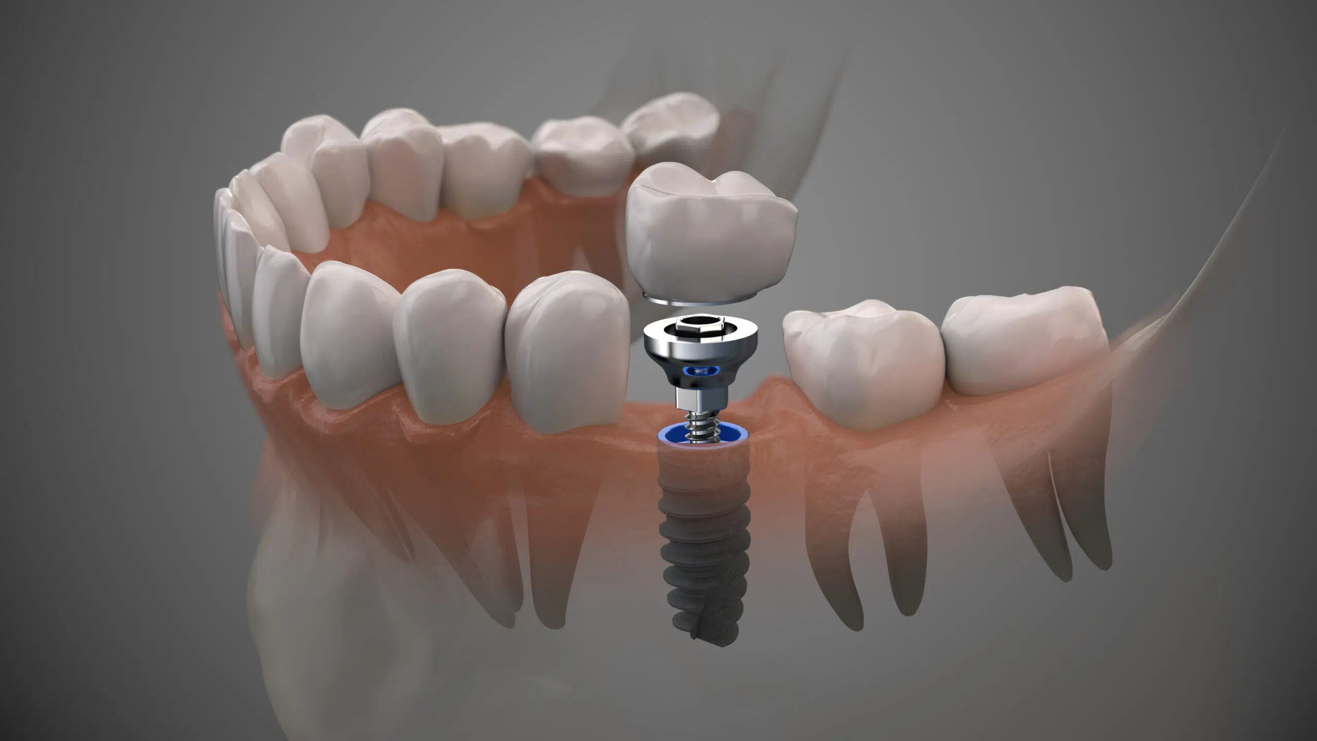 Smile Stories: How Dental Implants Change Lives for the Better