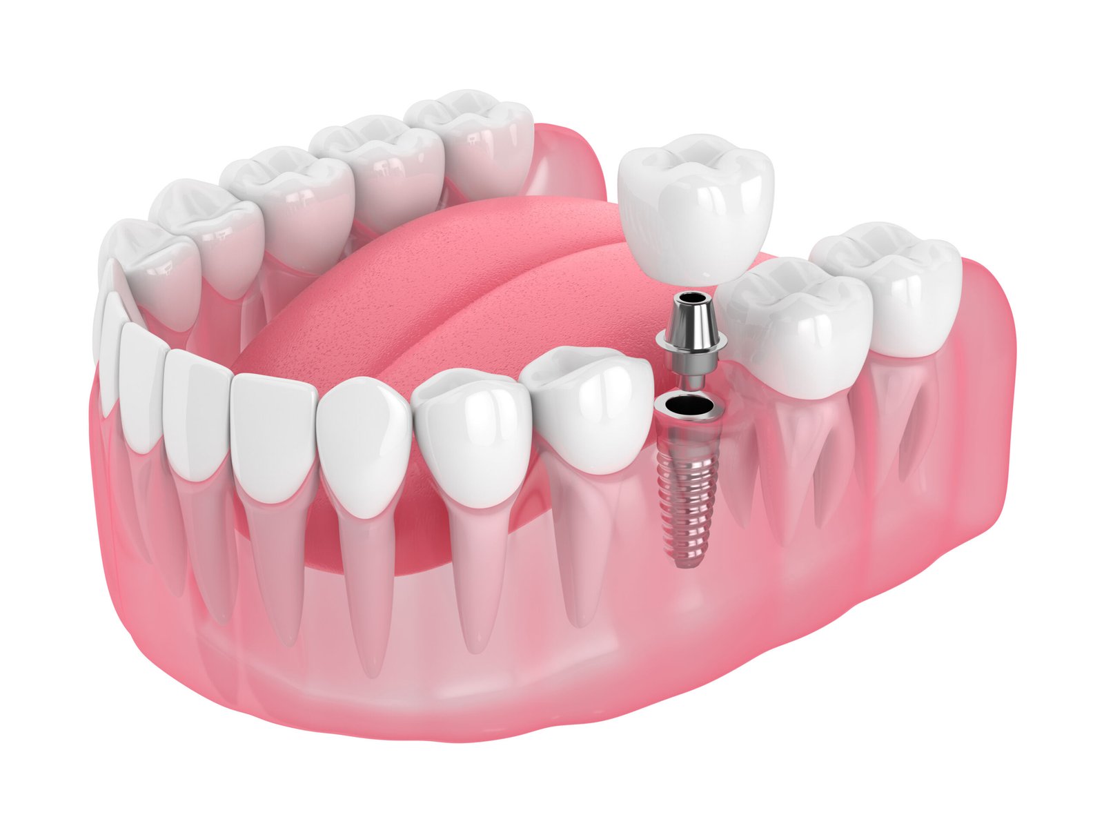 One Tooth Missing? Why Dental Implants Are Worth Considering