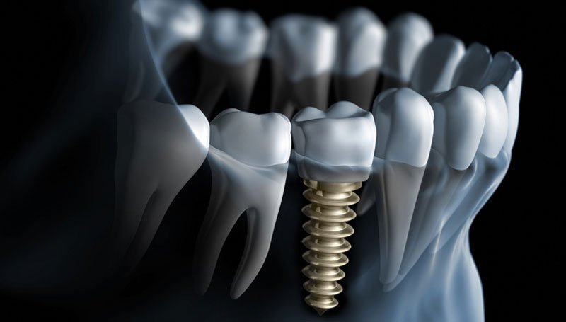 The Digital Age of Dentistry: Advancements in Dental Implant Technology