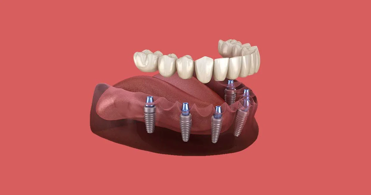 Regain Your Bite: How Dental Implants Restore Mouth Functionality