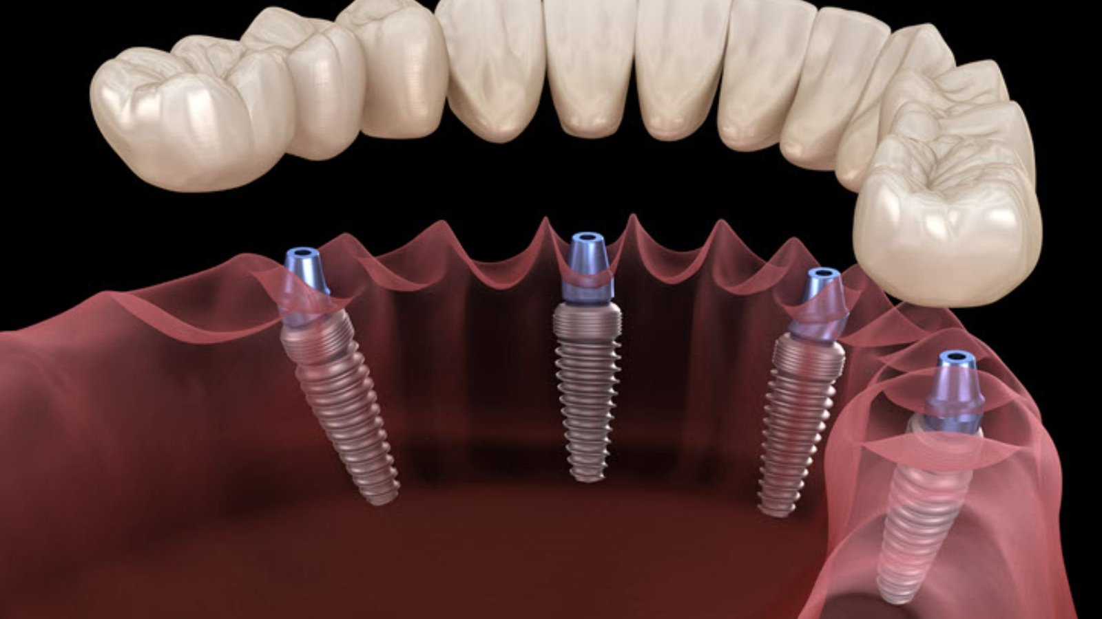 Road to Recovery: Understanding the Healing Process After Dental Implants