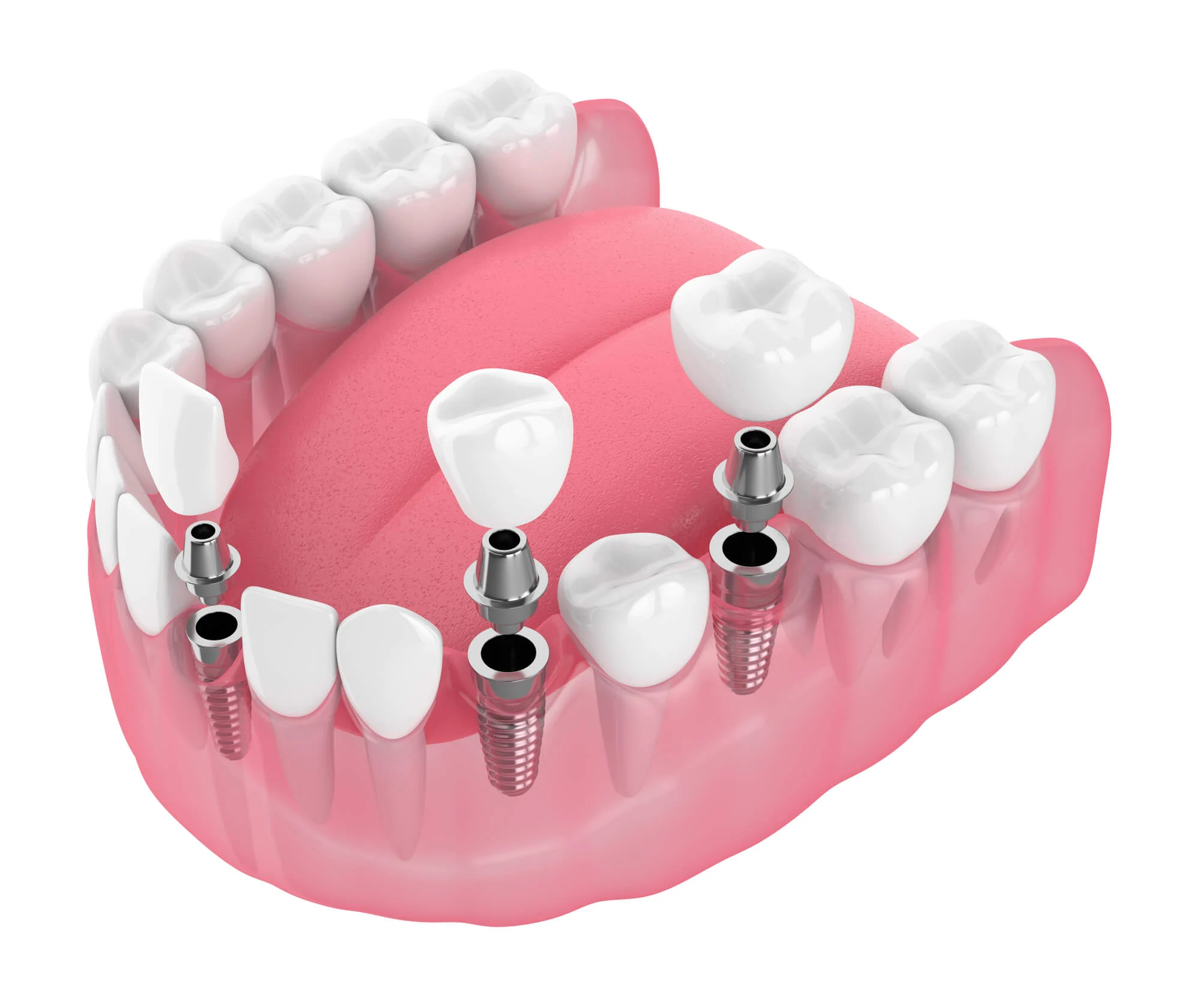 From Teeth to Face: Exploring the Impact of Dental Implants