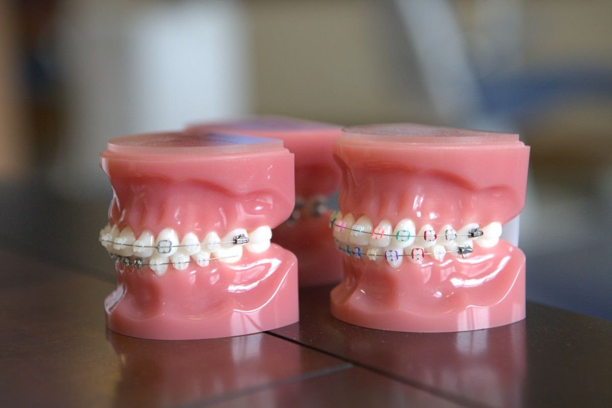 Fact or Fiction: Setting the Record Straight on Braces Myths