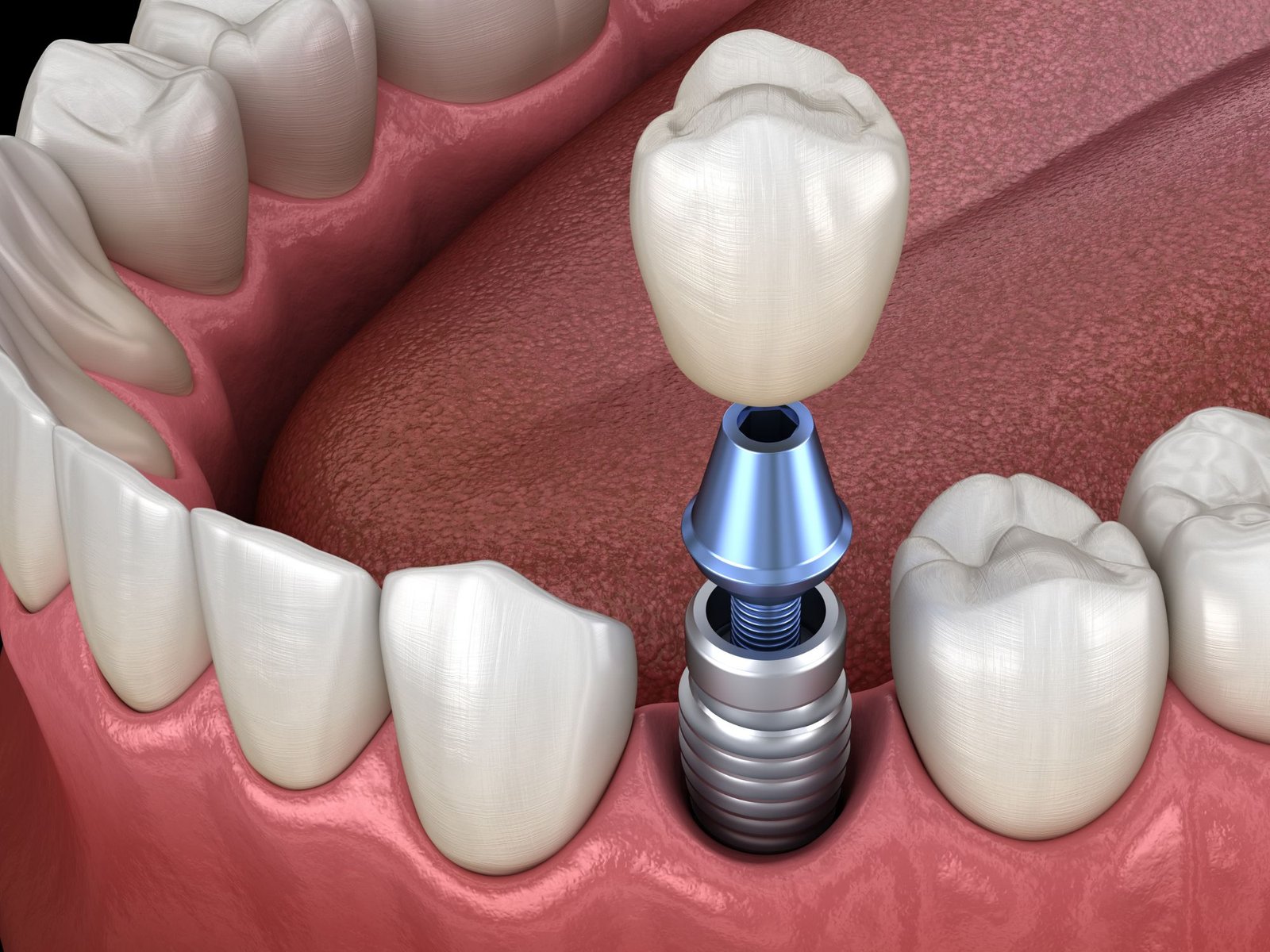 The Truth About Dental Implants and Pain: What You Need to Know