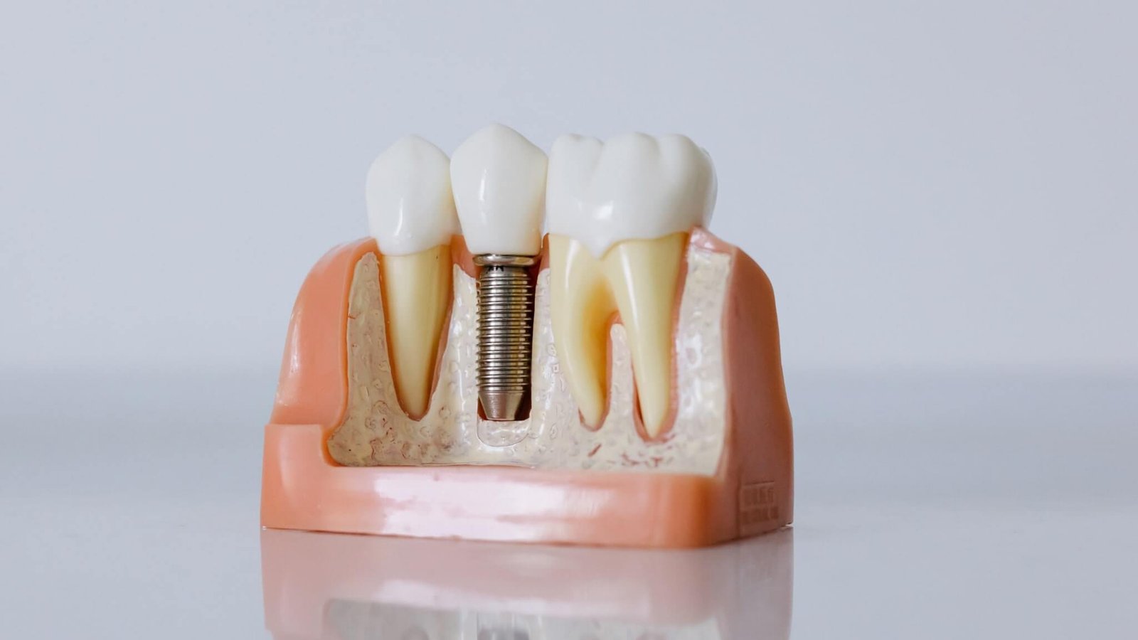 Enhancing Your Smile: How Dental Implants Work with Other Cosmetic Treatments