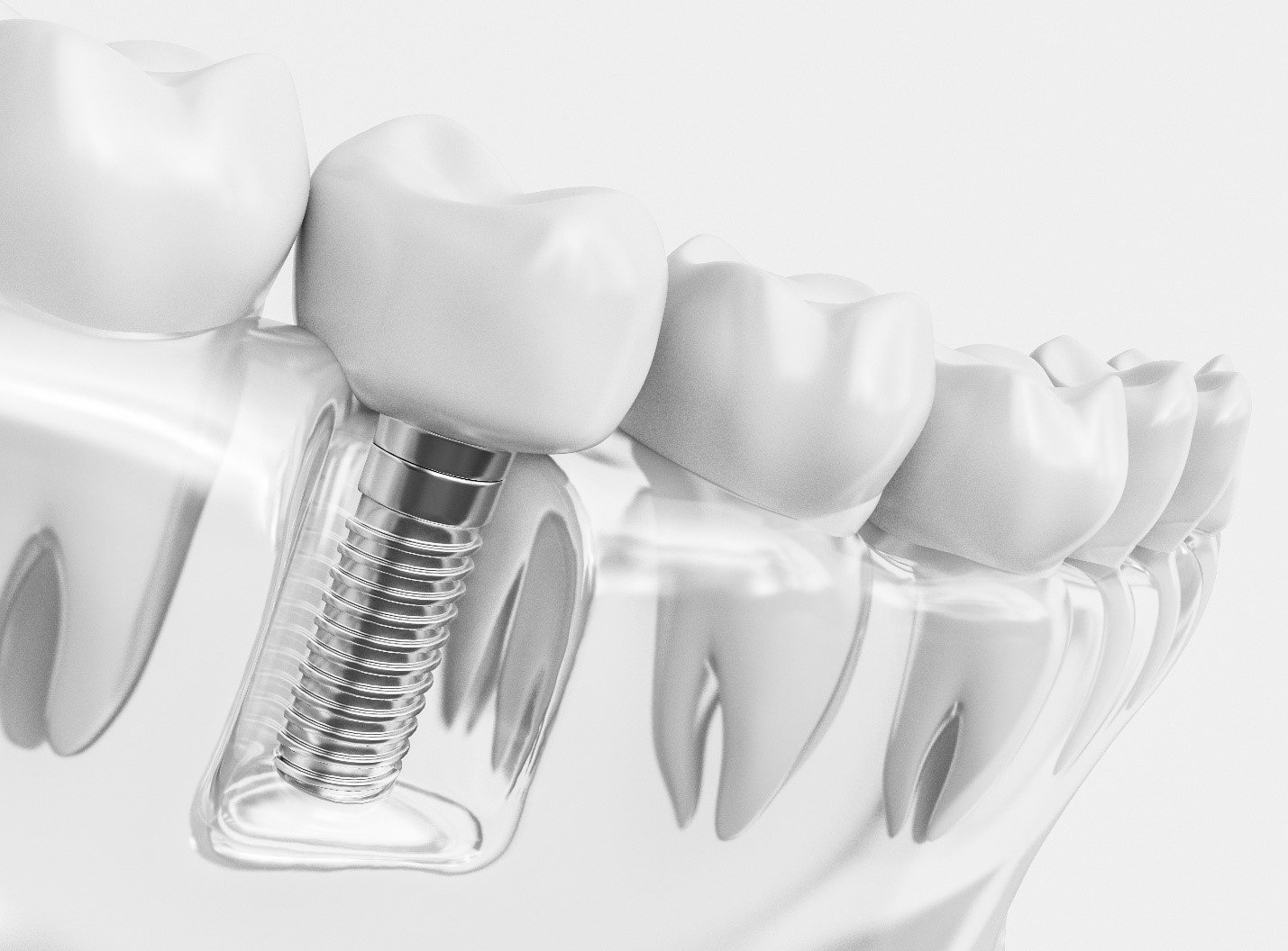 Dental Implants: Regaining Confidence in Eating and Speaking