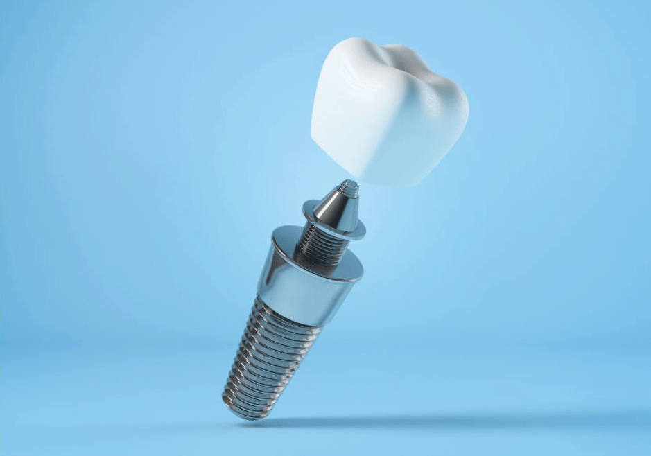 Dental Implants: Enhancing Your Quality of Life and Well-being