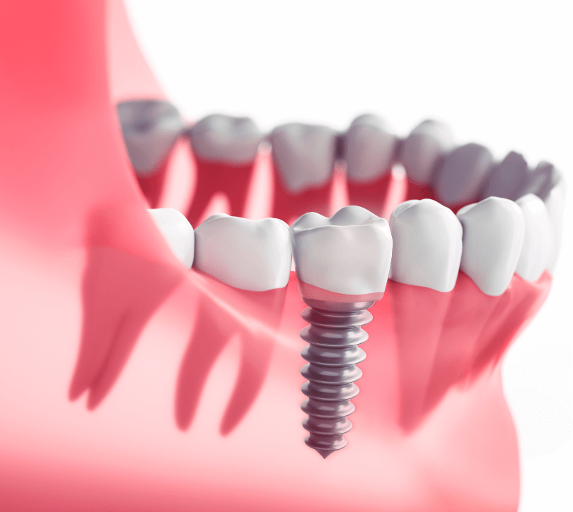 Ageless Smiles: How Dental Implants Benefit Seniors