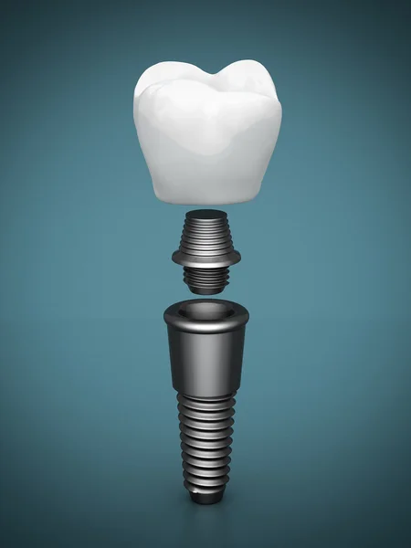 Myth vs. Reality: What You Need to Know About Dental Implants