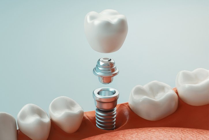Dental Implants: Elevating Your Quality of Life One Smile at a Time