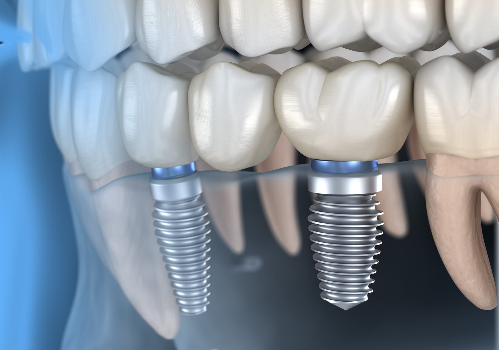Choosing Your Dental Implant Expert: Tips for Finding the Ideal Dentist