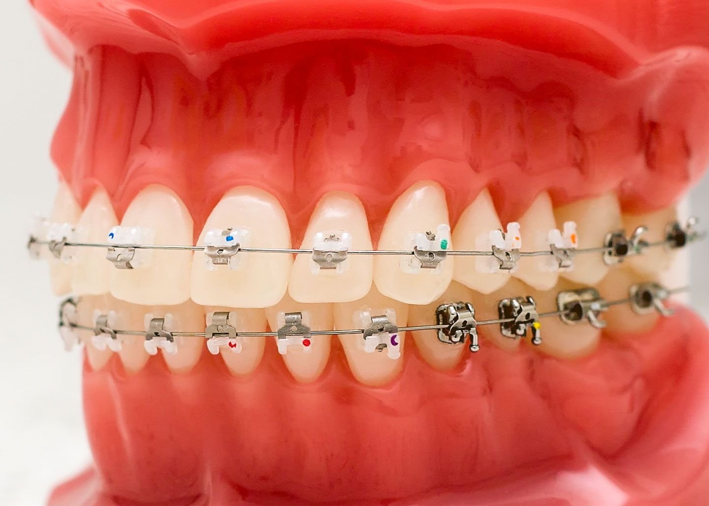 Brace Yourself for Change: Understanding the Duration of Orthodontic Treatment