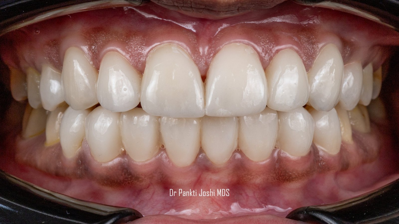 ”Behind Every Perfect Smile: The Veneers Advantage’’