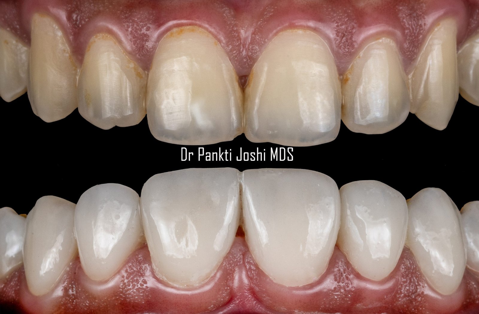 ” From stained to Stuning : The Magic of Dental Veneers’’