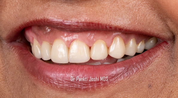 Bright, Bold & Beautiful: The Power of Veneers
