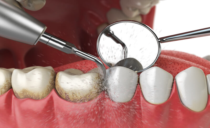 DOES SCALING MAKE TEETH LOOSE ? EXPLAINED