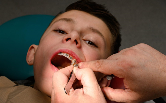 Do Braces Hurt? How to Prepare Your Child for Braces