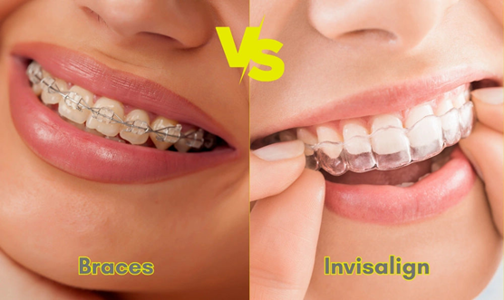 How to Choose Between Braces and Invisalign