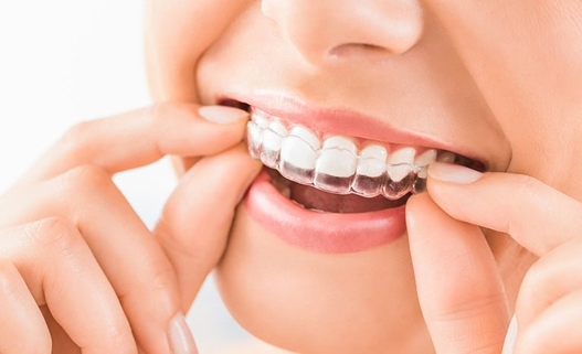 What’s the Difference Between DIY Aligners and Invisalign?