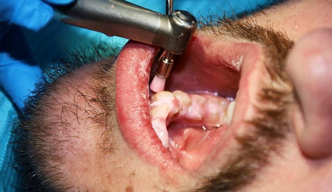 Dose Scaling Hurt? Patient Experience