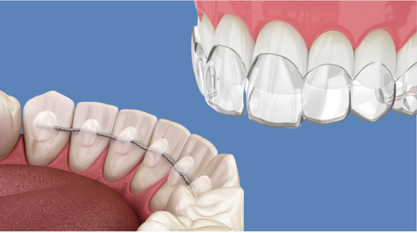 Why Retainers Are Essential After Braces