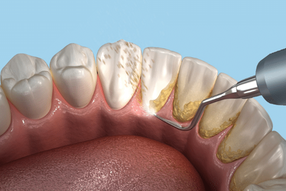 Why Dental Scaling is More Than Just Cleaning.