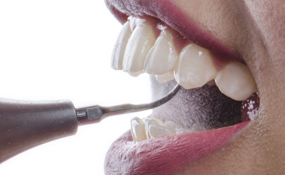 SCALING: A HYGIENIST’S ESSENTIAL TOOL