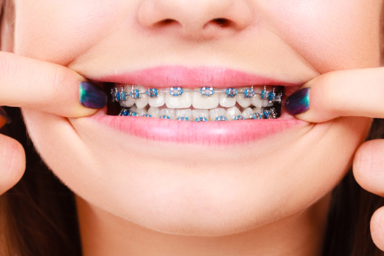 Can You Get Braces on Just Upper or Lower Teeth?
