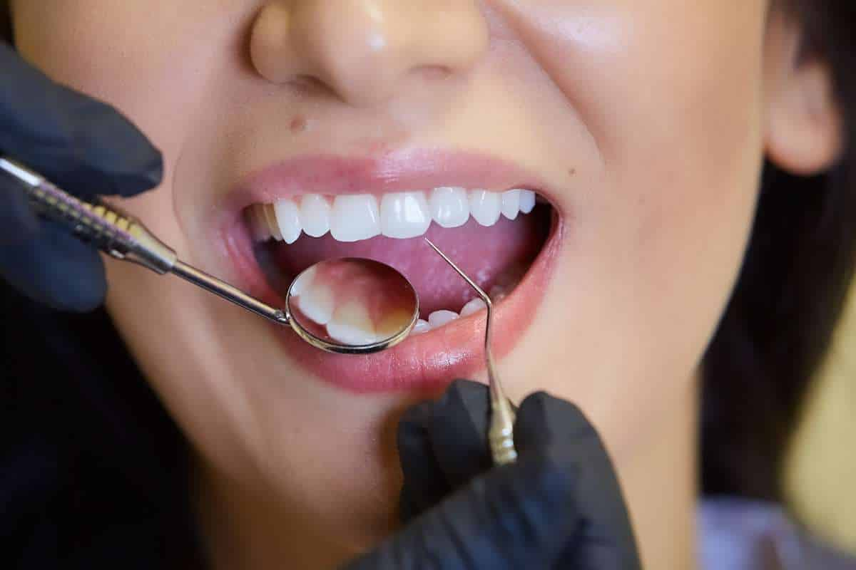 HOW SCALING HELPS MAINTAIN FRESH BREATH